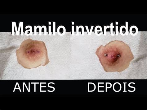 bico invertido fotos|Mamilo invertido: o que é, causas e tratamento